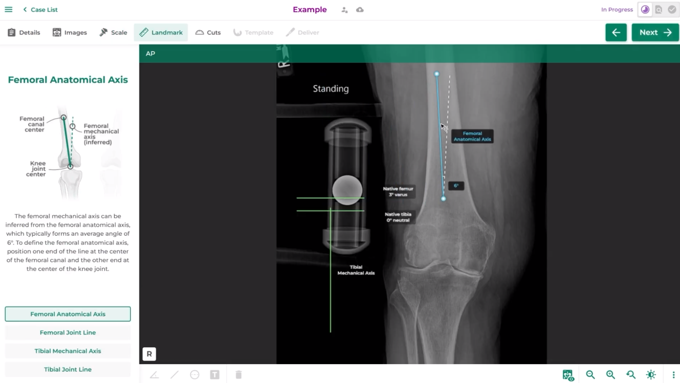 Intellijoint VIEW preoperative planning application